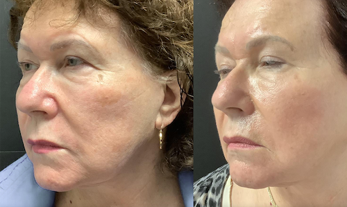 rf laser face lift before after mississauga oakville